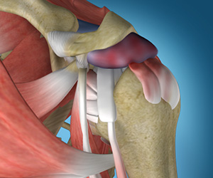 Shoulder Impingement - Educational Picture