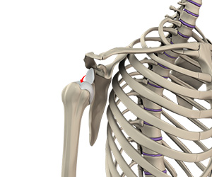 Shoulder Instability - Educational Picture