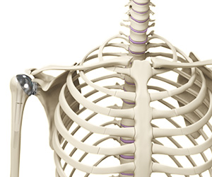 Shoulder Joint Replacement - Educational Picture