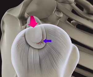 Shoulder Labral Tear with Instability - Educational Picture