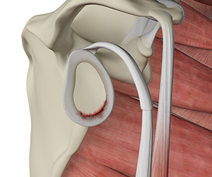 Shoulder Labral Tear - Educational Picture