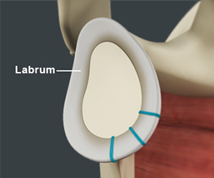 Shoulder Labrum Reconstruction - Educational Picture