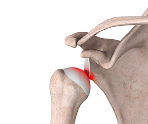 Shoulder Stabilization - Educational Picture