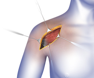 Shoulder Surgery - Educational Picture