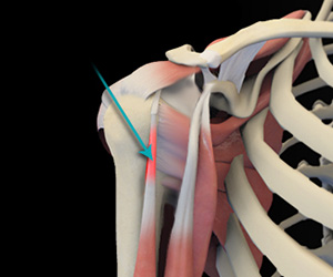 Shoulder Tendonitis - Educational Picture