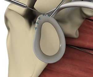 SLAP Repair - Educational Picture