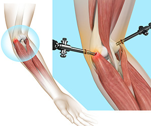 Tennis Elbow Surgery - Educational Picture