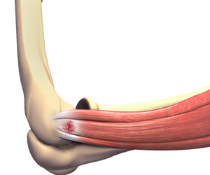 Tennis Elbow - Educational Picture