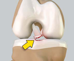 Tibial Eminence Fracture - Educational Picture