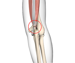 Triceps Injuries - Educational Picture