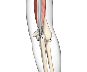 Triceps Repair - Educational Picture