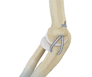UCL Reconstruction (Tommy John Surgery) - Educational Picture