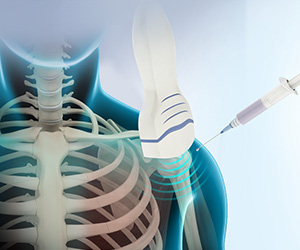 Ultrasound-Guided Shoulder Injections - Educational Picture