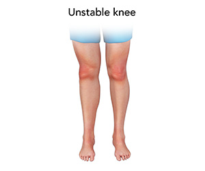 Unstable Knee - Educational Picture
