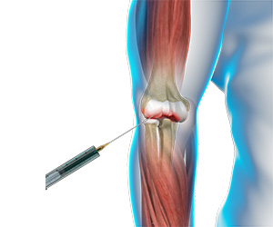 Viscosupplementation for Elbow Arthritis - Educational Picture