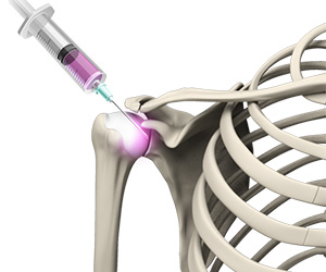 Viscosupplementation for Shoulder Arthritis - Educational Picture