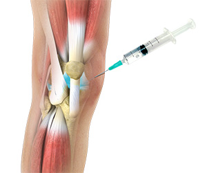 Viscosupplementation - Educational Picture