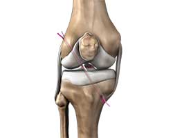 Picture of ACL Reconstruction