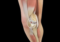 Picture of ACL Tears
