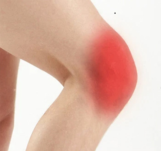 Picture of Anterior Knee Pain