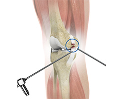 Picture of Arthroscopic Reconstruction of the Knee for Ligament Injuries