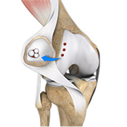 Picture of Cartilage Restoration of the Patellofemoral Joint