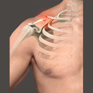 Picture of Clavicle Fracture