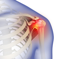 Picture of Frozen Shoulder