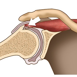 Picture of Internal Impingement of the Shoulder