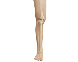 Picture of Knee Dislocation