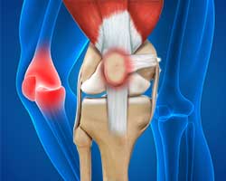 Picture of Knee Injury