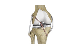 Picture of Knee Ligament Reconstruction