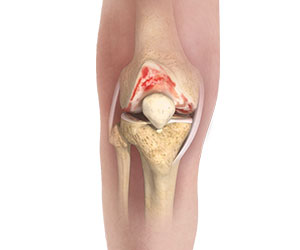 Picture of Knee Osteoarthritis