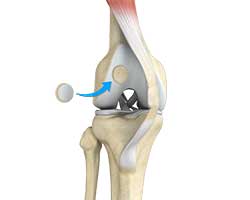 Picture of Knee Preservation Surgery