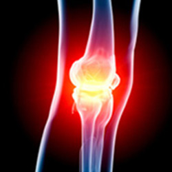 Picture of Knee Sports Injuries