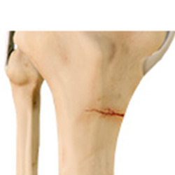 Picture of Knee Stress Fractures