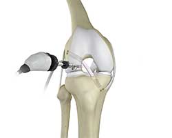 Picture of Knee Trauma Reconstruction