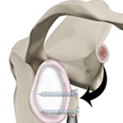 Picture of Latarjet Procedure
