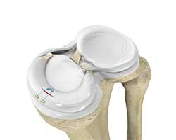 Picture of Meniscal Repair Surgery
