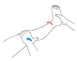 Picture of Nonoperative Treatments for ACL Injuries