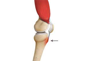 Picture of Osgood-Schlatter Disease