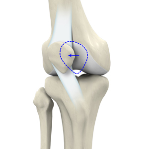 Picture of Patellar Dislocation/Patellofemoral Dislocation