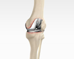Picture of Revision Knee Ligament Reconstruction