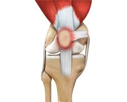 Picture of Runner's Knee