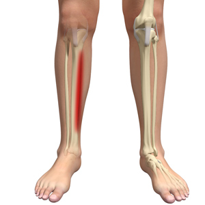 Picture of Shin Splints