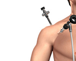 Picture of Shoulder Arthroscopy