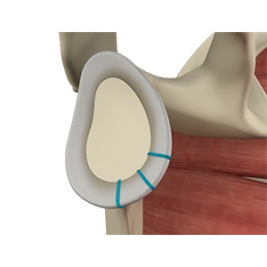 Picture of Shoulder Labrum Reconstruction