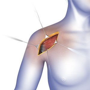 Picture of Arthroscopic Shoulder Surgery