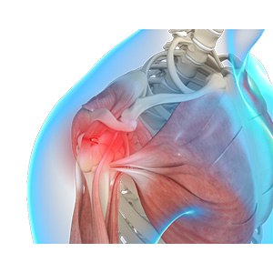 Picture of Shoulder Trauma