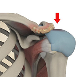 Picture of Subacromial Impingement Syndrome